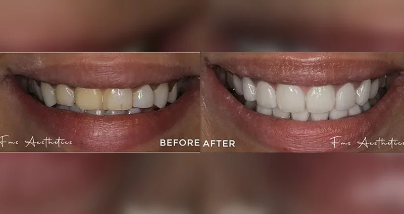 Hollywood Smile Makeover