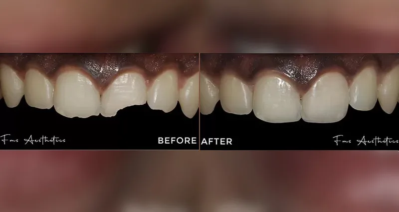 Hollywood Smile Makeover