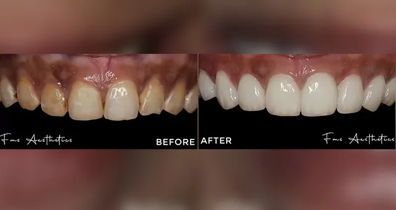 Hollywood Smile Makeover