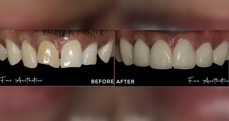 Hollywood Smile Makeover