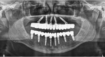 All-on-4-Dental-Implants-FMS-DENTAL