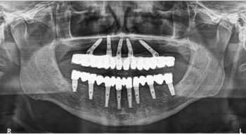 All-on-4-Dental-Implants-FMS-DENTAL