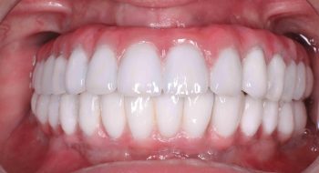 all-on-4-hybrid-prosthesis