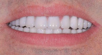 all-on-4-procera-crown-and-bridge