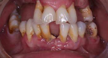 all-on-four-implant-surgery